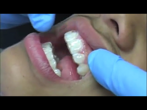 how to make retainers fit again