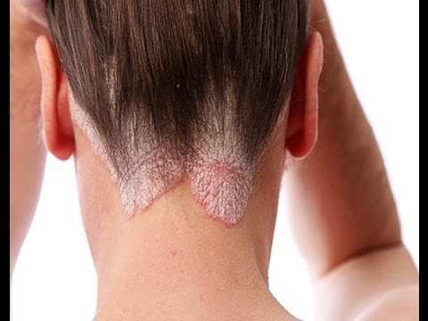 how to cure psoriasis on the scalp