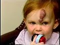 Hemangioma Forehead/TLC/part 2