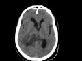 Glioblastoma follow up admission copyright x raytoday com 2009