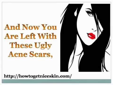 how to get rid of acne scars at the back