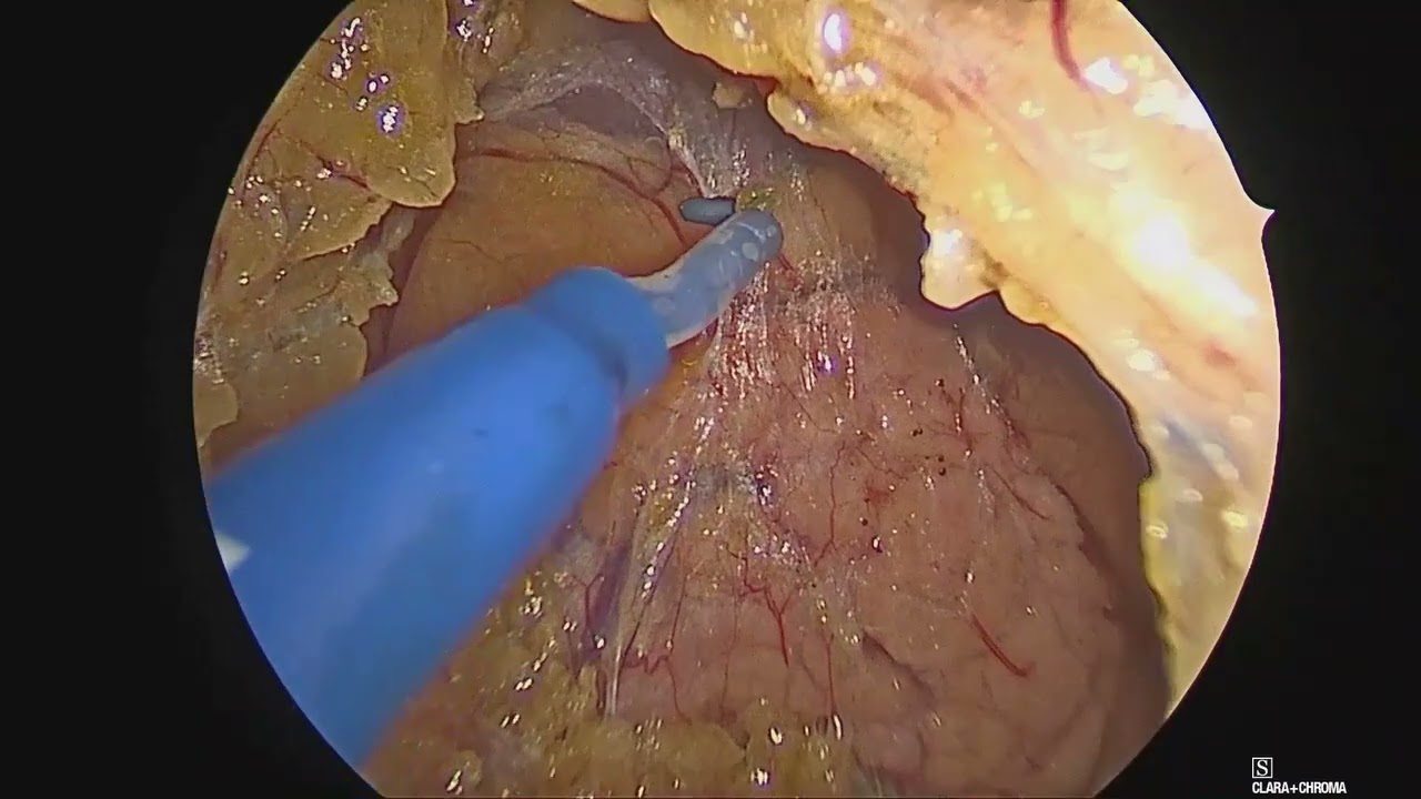 Sigmoid Colon Cancer Laparoscopic Left Hemicolectomy