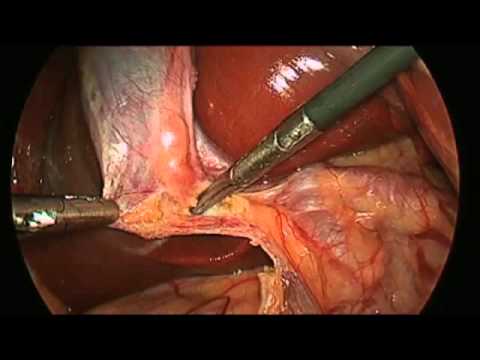 how to perform gallbladder surgery