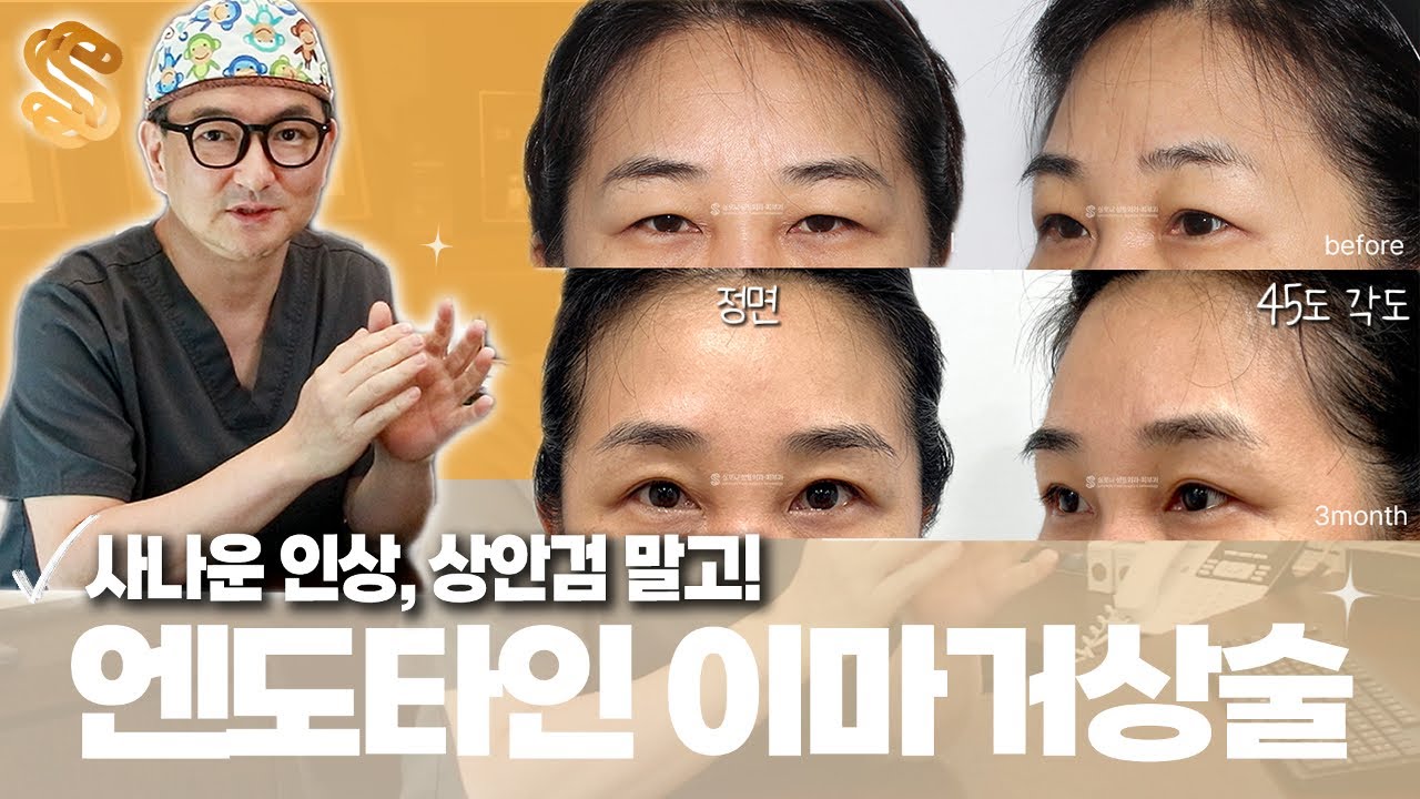 사납고 무거워 보이는 인상, 상안검 말고 엔도타인 이마거상!