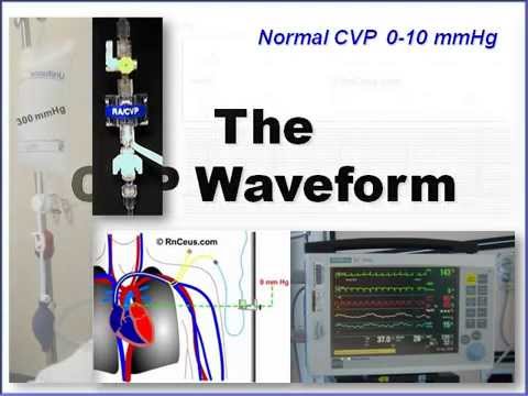how to obtain cvp reading