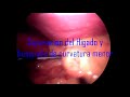 Bypass Gastrico Dr. Reinaldo Quijada. Venezuela Bypass Gastrico Dr. Reinaldo Quijada. Venezuela