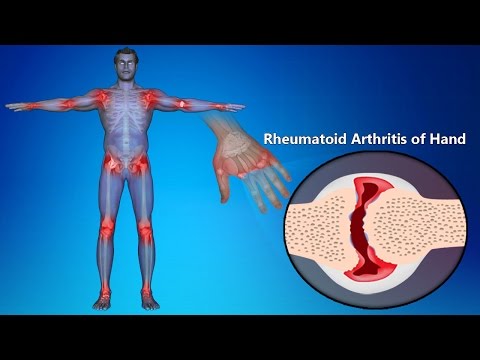 how to treat rheumatoid arthritis