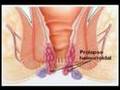 Hemorroidectomia PPH. Ethicon. www.obesidadycirugia.es