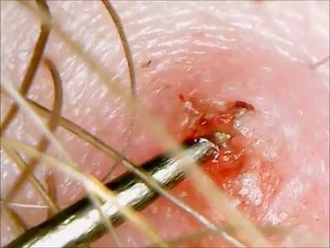 Super Deep Ingrown Hair Pimplepoppingvideos Net