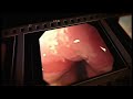 Barrett Esophagus Film