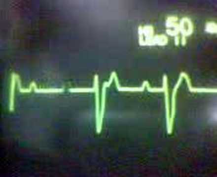 how to treat 3rd degree heart block