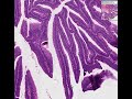 Histopathology Colon--Villous adenoma Histopathology Colon--Villous adenoma
