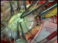 mitral valve prolapse mitral valve prolapse