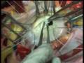mitral valve prolapse