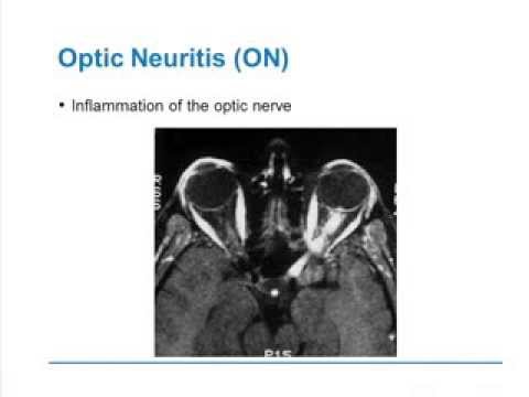 how to cure optic neuritis naturally