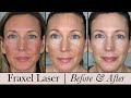 Fraxel Face Laser ~ Before & After! 3 Month Update