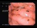 BLEEDING STOMACH ULCERS