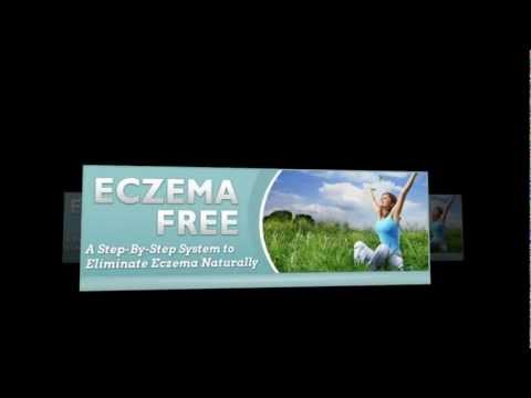 how to cure nummular eczema