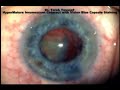 Hypermature intumescent Cataract trypan blue \"Vision blue\" Hypermature intumescent Cataract trypan blue \"Vision blue\"