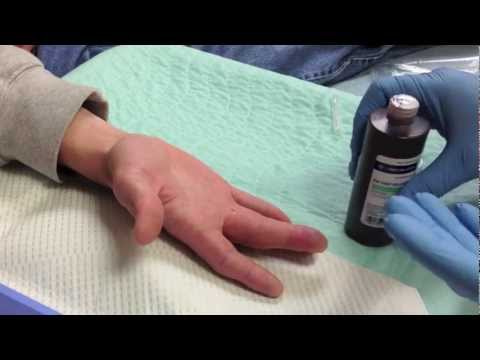 how to drain finger infection