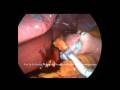 LAP-Magenband-ambula
