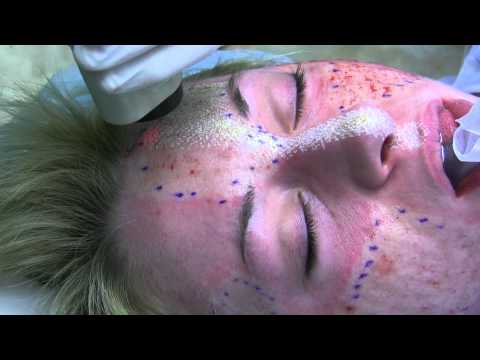 Deep FX and Active FX Laser for Acne Scars by Dr. Joe Niamtu, III