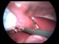 The fist transvaginal hibryd cholecystectomy on a porcine modell in Hungary - Short version
