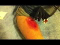 Draining pus from an Abscess in leg --WARNING-- pus and some blood