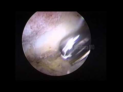 Distal clavicle resection