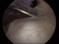 Nates Labrum surgery 2 of 2