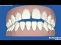 A E Invisalign Clincheck.avi