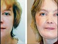 Face Transplants: Mixed Results