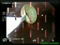 Gastrostomy Tube Removal Gastrostomy Tube Removal
