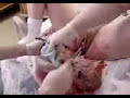 Vaginal birth