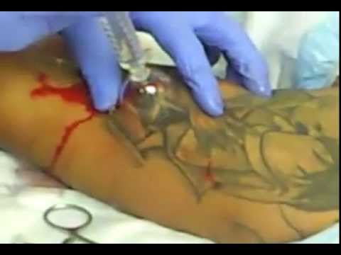 how to drain staph infection