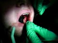 dentistry-horrors-wisdom-tooth-procedure-full.html