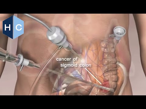 Colon Surgery - http://www.houstoncolon.com/laparoscopic-surgery Laparoscopic Colon Surgery is the preferred technique performed by the surgeons at Colorectal Surgical Assoc...