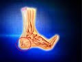 Severs Disease www.footkneepain.com.au