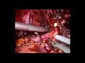 Anastomosi vescico-uretrale laparoscopica. Asl9 Grosseto