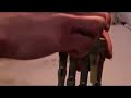 i-limb repair i-limb repair