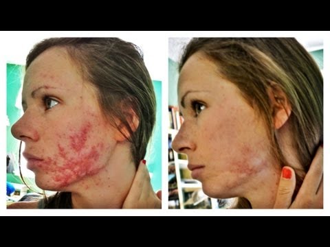 Katy perry zits scars wherein am i able to buy x out acne treatment