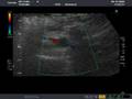 Double left renal artery AND retro-aortic left renal vfein