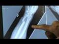 Frank Shamrock's Right Hand of Death Recovery
