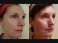 Laser Skin Rejuvenation. Fractional CO2 Laser Skin Resurfacing