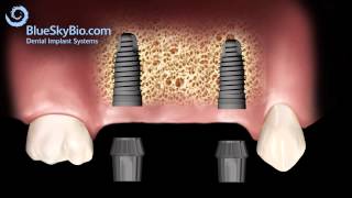 Implant Bridge