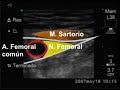 ecografía del nervio femoral ecografía del nervio femoral