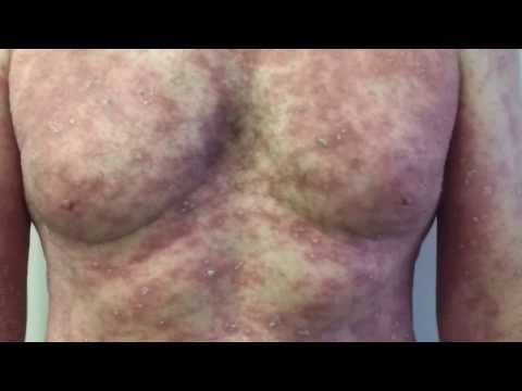how to treat pityriasis rosea