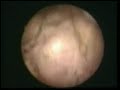 TURP (Transurethral Resection of the Prostate)