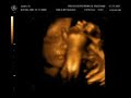 4D Ultrasound of baby girl at 29 weeks