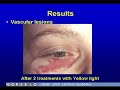 Norseld Coper bromide laser Video